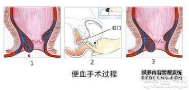 成人鼻腔出血止血方法视频,成人鼻腔出血紧急止血技巧视频解析