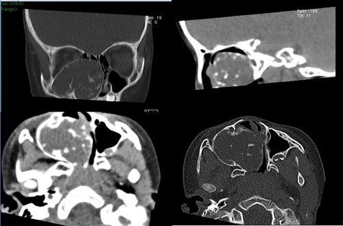 成人鼻腔出血止血方法视频,成人鼻腔出血紧急止血技巧视频解析