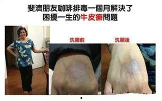 成人灌肠如何灌法视频